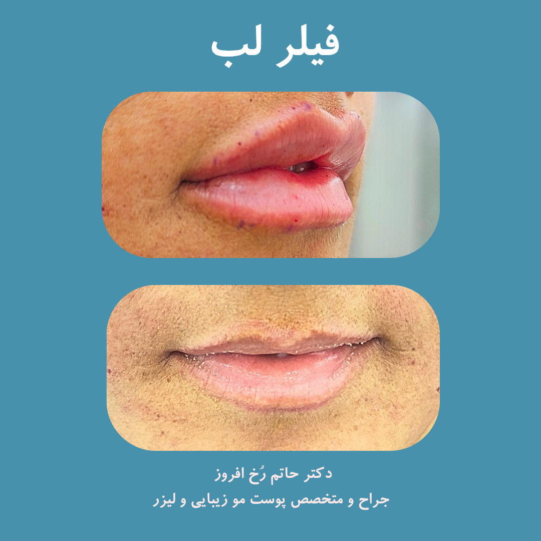 تفاوت فیلر و بوتاکس | کدام مناسب شماست؟