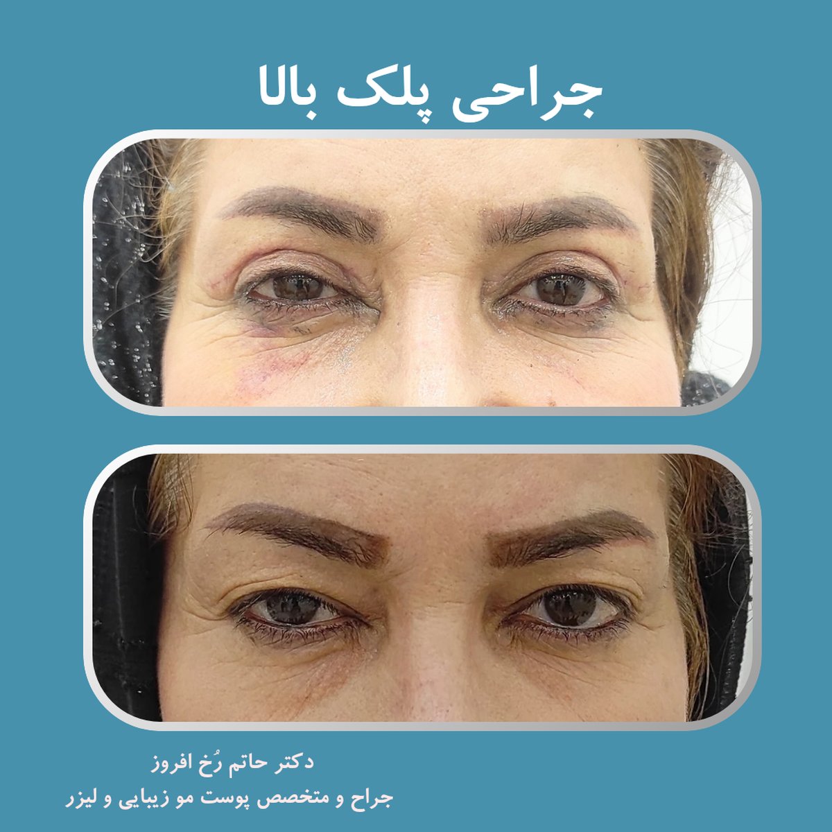 جراحی پلک