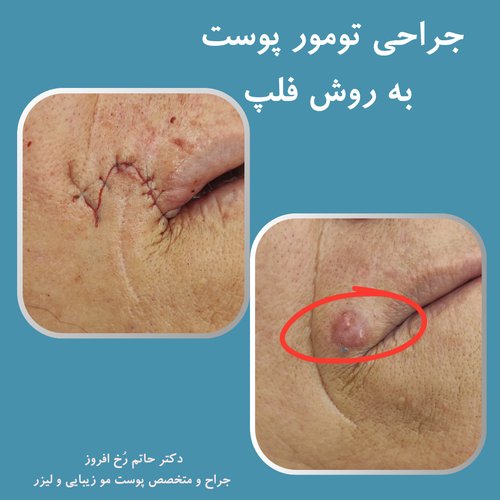 جراحی تومور/توده/کیست
