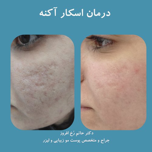 زگیل و میخچه