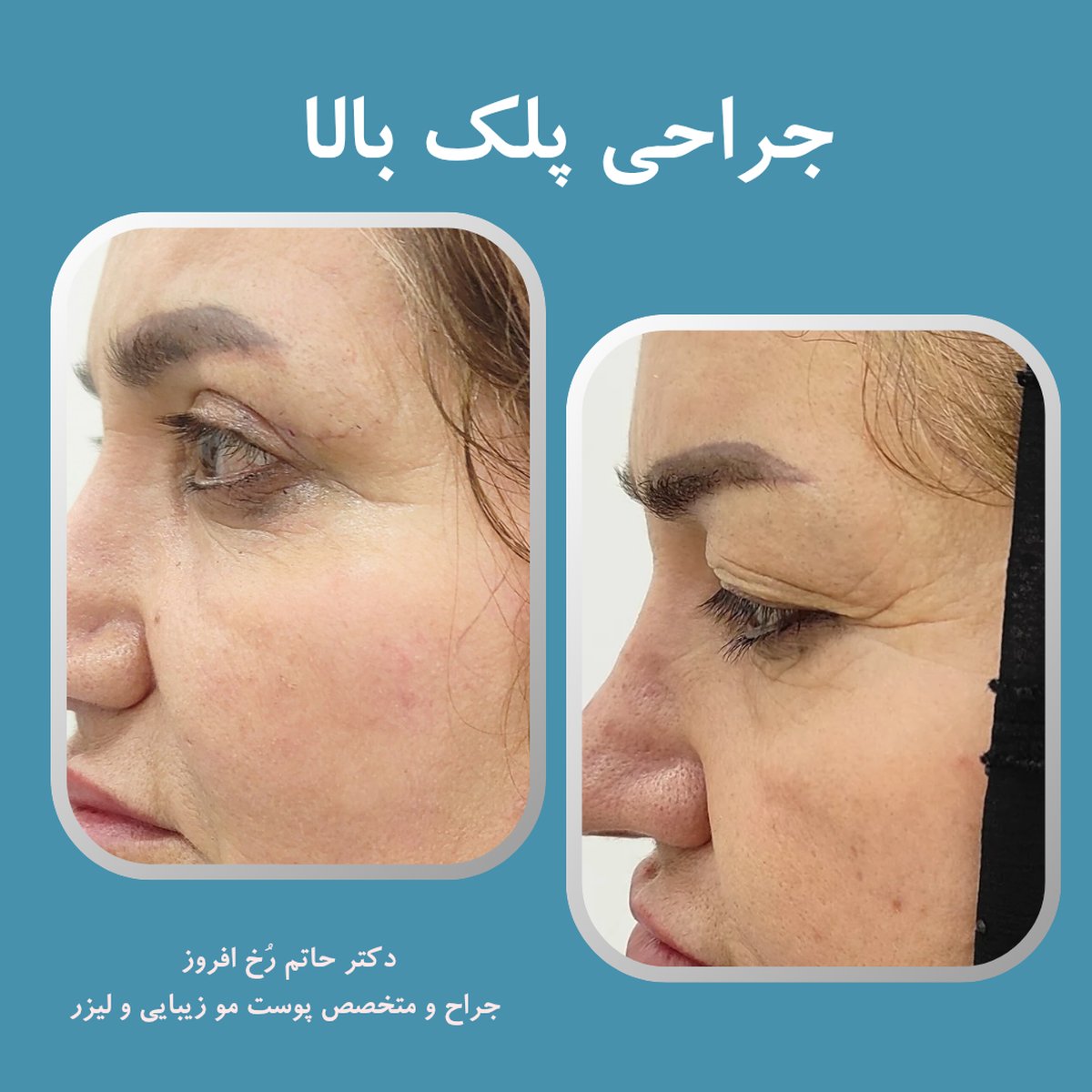 جراحی پلک