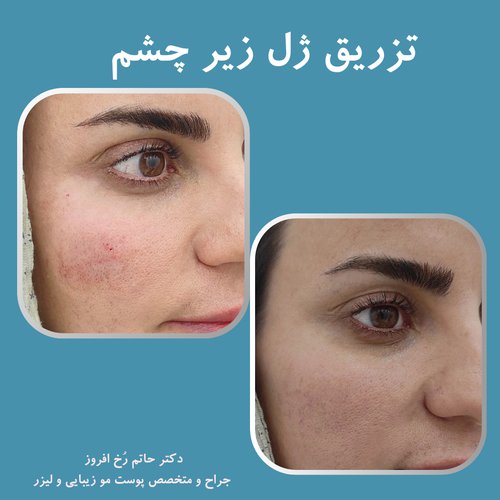 تیرگی/گودی زیر چشم