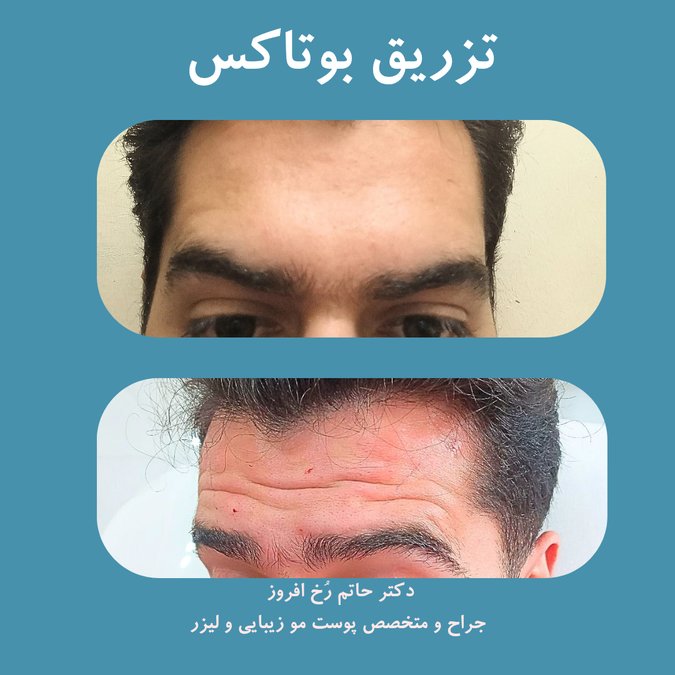 بوتاکس پیشانی