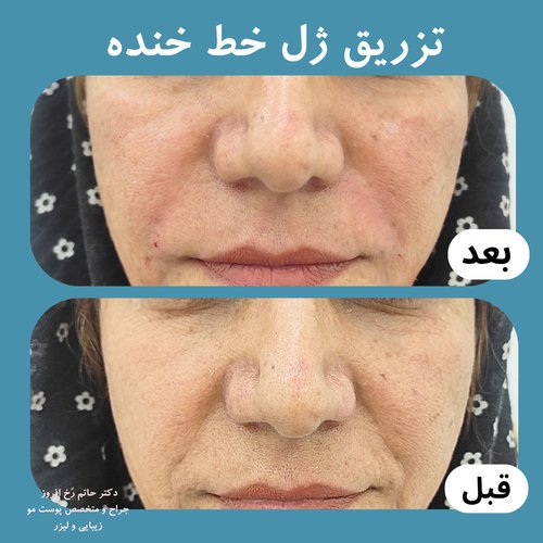 رفع خط لبخند