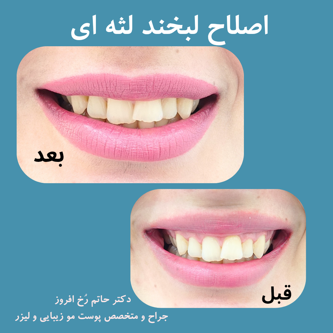 بوتاکس لبخند لثه‌ای