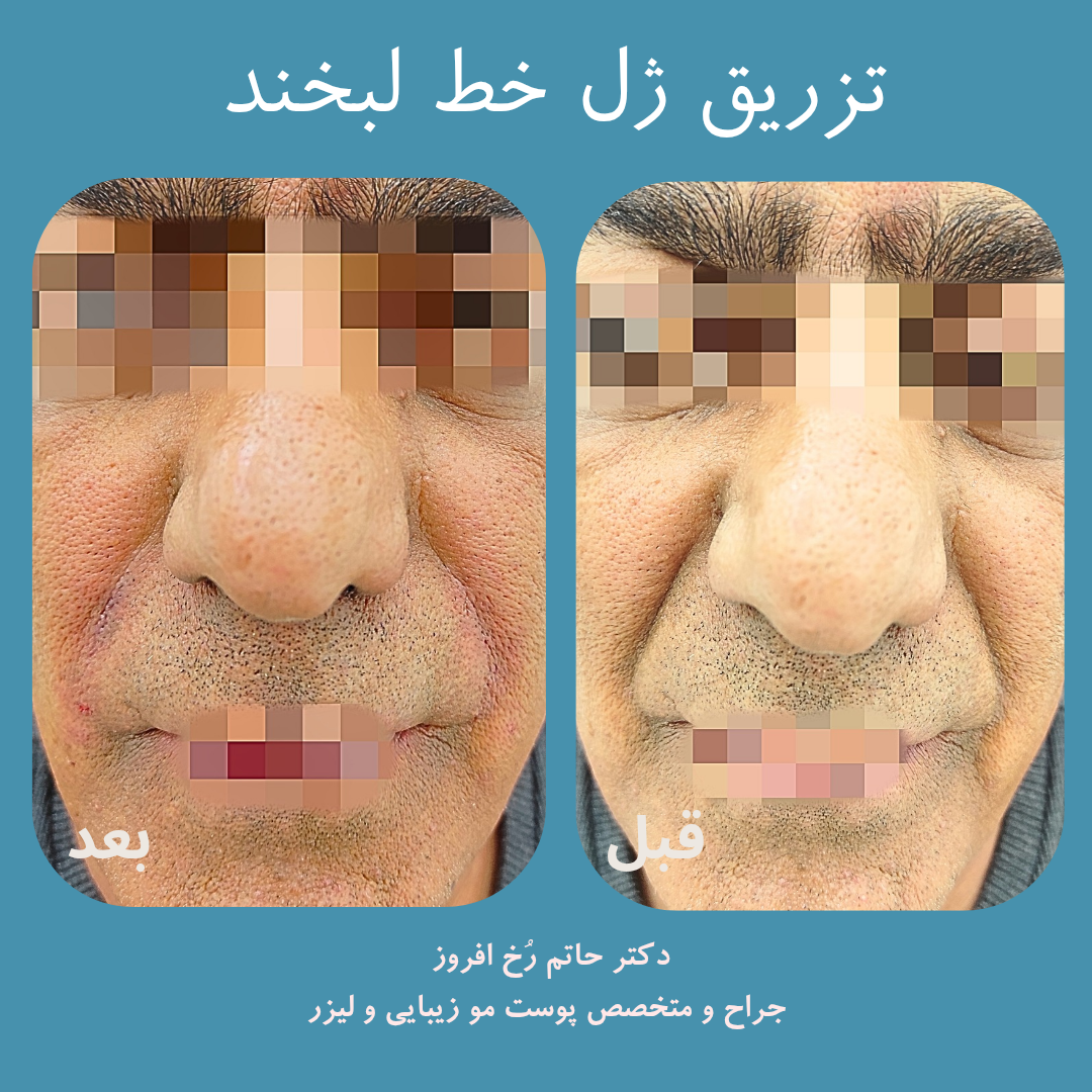 رفع خط لبخند
